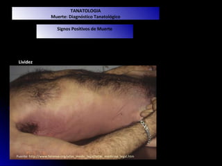 TANATOLOGIA
                     Muerte: Diagnóstico Tanatológico
                       Muerte: Diagnóstico Clínico

                         Signos Positivos de Muerte




 Lividez




Fuente: http://www.forense.org/atlas_medic_legal/atlas_medicina_legal.htm
 