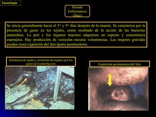 Tanatología
                                                      Periodo
                                                    Enfisematoso
                                                       (Días)

   Se inicia generalmente hacia el 3er y 5to días después de la muerte. Se caracteriza por la
   presencia de gases en los tejidos, como resultado de la acción de las bacterias
   anaerobias. La piel y los órganos macizos adquieren un aspecto y consistencia
   esponjosa. Hay producción de vesículas oscuras voluminosas. Las mujeres grávidas
   pueden tener expulsión del feto (parto postmortem).


     Hinchazón de tejidos y protusión de órganos por los
                 gases de la putrefacción                          Expulsión postmortem del feto
 