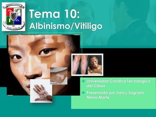 Tema 10: 
Albinismo/Vitiligo 
 Universidad Catòlica Tecnologica 
del Cibao 
 Presentado por Treicy Sagrario 
Mena Marte 
 