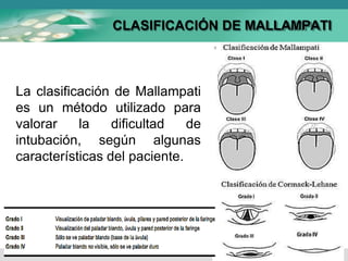 La clasificación de Mallampati
es un método utilizado para
valorar la dificultad de
intubación, según algunas
características del paciente.
CLASIFICACIÓN DE MALLAMPATI
 