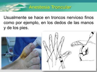 Anestesia Troncular
Usualmente se hace en troncos nervioso finos
como por ejemplo, en los dedos de las manos
y de los pies.
 
