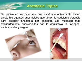 Anestesia Tópica
Se realiza en las mucosas, que es donde únicamente hacen
efecto los agentes anestésicos que tienen la suficiente potencia
para producir anestesia por contacto. Las mucosas más
frecuentemente anestesiadas son la conjuntiva, la faríngea,
encías, uretra y vagina.
 