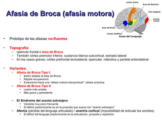 • Prototipo de las afasias no-fluentes
• Topografía:
– opérculo frontal o área de Broca
– También córtex premotor inferior, sustancia blanca subcortical, estriado lateral
– En los casos graves: córtex prefrontal dorsolateral, opercular, rolándica y parietal anterolateral
• Variantes:
– Afasia de Broca Tipo I:
• lesión aislada al área de Broca
• Rápida recuperación
• Evoluciona hacia una “afasia motora transcortical” / afasia anómica
– Afasia de Broca Tipo II
• Lesión más amplia
• Más grave y persistente
– El Síndrome del acento extranjero
• Variante muy poco frecuente
• El déficit predominante es en la prosodia que suena con “acento extranjero”
– Afemia (pérdida del lenguaje articulado) / anartria cortical (imposibilidad de articular los sonidos)
• El déficit del lenguaje predominante es la articulación, prosodia y repetición
Afasia de Broca (afasia motora)Afasia de Broca (afasia motora)
 