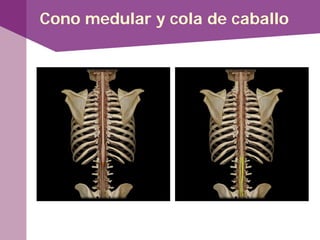 Cono medular y cola de caballo
 