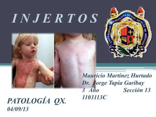 INJERTOS

PATOLOGÍA QX.
04/09/13

Mauricio Martínez Hurtado
Dr. Jorge Tapia Garibay
3 Año
Sección 13
1103113C

 