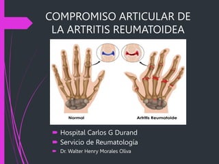 COMPROMISO ARTICULAR DE
LA ARTRITIS REUMATOIDEA
 Hospital Carlos G Durand
 Servicio de Reumatología
 Dr. Walter Henry Morales Oliva
 