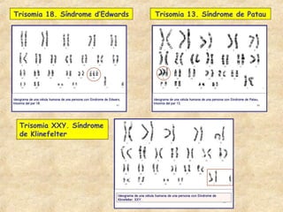 Trisomia 18. Síndrome d’Edwards   Trisomia 13. Síndrome de Patau




 Trisomia XXY. Síndrome
 de Klinefelter
 