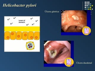 Helicobacter pylori
Úlcera gástrica

Úlcera duodenal

 
