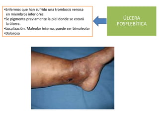 ÚLCERA
POSFLEBÍTICA
•Enfermos que han sufrido una trombosis venosa
en miembros inferiores.
•Se pigmenta previamente la pie...