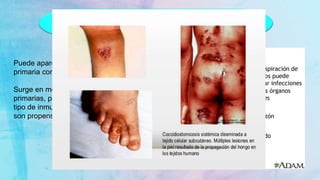 Coccidioimicosis Diseminada
Puede aparecer tanto en la forma
primaria como en la crónica.
Surge en menos del 1% de las formas
primarias, pero los pacientes con algún
tipo de inmunosupresión
son propensos a ella.
 