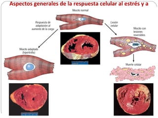 Aspectos generales de la respuesta celular al estrés y a
los estímulos nocivos
5
 propiedad de los organismos vivos que consiste en su capacidad de mantener
una condición interna estable compensando los cambios en su entorno
mediante el intercambio regulado de materia y energía con el exterior lo que
es llamado homeostasis
 Cuando las demandas fisiológicas son aumentadas por estímulos o por alguna
lesión tenemos:
causas: isquemia, infección, toxicidad, reacciones inmunitarias, etc.
adaptaciones celulares reversibles, que pueden ser:
HIPERPLASIA que es el aumento del número de células
HIPERTROFIA que es el aumento de tamaño de las células
ATROFIA es la respuesta donde existe la disminución del
tamaño y la función de las células
METAPLASIA las células cambian de una célula madura a otro
tipo de célula.
 Cuando el estímulo dañino persiste sobrepasando la capacidad de adaptación
 