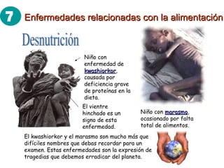 Desnutrición Niño con enfermedad de  kwashiorkor , causada por deficiencia grave de proteínas en la dieta. El vientre hinchado es un signo de esta enfermedad. Niño con  marasmo , ocasionado por falta total de alimentos. El kwashiorkor y el marasmo son mucho más que difíciles nombres que debas recordar para un examen. Estas enfermedades son la expresión de tragedias que debemos erradicar del planeta. Enfermedades relacionadas con la alimentación 7 