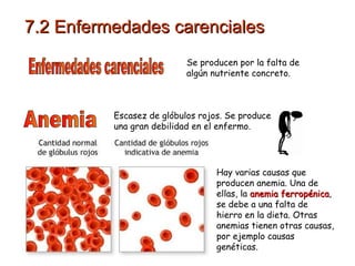 7.2 Enfermedades carenciales Enfermedades carenciales Anemia Se producen por la falta de algún nutriente concreto. Escasez de glóbulos rojos. Se produce una gran debilidad en el enfermo. Hay varias causas que producen anemia. Una de ellas, la  anemia ferropénica , se debe a una falta de hierro en la dieta. Otras anemias tienen otras causas, por ejemplo causas genéticas. 