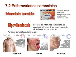 Escasez de vitaminas en la dieta. Se producen diversos trastornos, según la vitamina de la que se trate. Hipovitaminosis Ya vimos antes algunos ejemplos: RAQUITISMO  PELAGRA  ESCORBUTO Enfermedades carenciales Si nuestra dieta es correcta no necesitaremos tomar complementos vitamínicos extra. 7.2 Enfermedades carenciales 