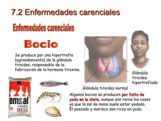 Bocio Se produce por una hipertrofia (agrandamiento) de la glándula tiroides, responsable de la fabricación de la hormona tiroxina.  Algunos bocios se producen  por falta de yodo en la dieta , aunque son raros los casos ya que la sal de mesa suele estar yodada. El pescado y marisco son ricos en yodo. Enfermedades carenciales 7.2 Enfermedades carenciales Glándula tiroides hipertrofiada Glándula tiroides normal 