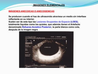 IMÁGENES ELEMENTALES
IMÁGENES ANECOICAS O ANECOGENICAS
Se producen cuando el haz de ultrasonido atraviesa un medio sin interfase
reflectante en su interior.
Suelen ser de este tipo las Lesiones Ocupantes de Espacio (LOES),
totalmente líquidas como los quistes, que además tienen el Artefacto
denominado Refuerzo Acústico Posterior, la parte blanca como cola,
después de la imagen negra
 