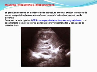 IMÁGENES HIPOECOICAS O HIPOECOGENICAS
Se producen cuando en el interior de la estructura anormal existen interfases de
menor ecogenicidad o en menor número que en la estructura normal que la
circunda.
Suele ser de este tipo las LOES correspondientes a tumores muy celulares, con
poca fibrosis y sin estructuras glandulares muy desarrolladas y con vasos de
paredes finas.
 
