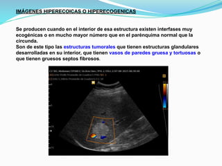 IMÁGENES HIPERECOICAS O HIPERECOGENICAS
Se producen cuando en el interior de esa estructura existen interfases muy
ecogénicas o en mucho mayor número que en el parénquima normal que la
circunda.
Son de este tipo las estructuras tumorales que tienen estructuras glandulares
desarrolladas en su interior, que tienen vasos de paredes gruesa y tortuosas o
que tienen gruesos septos fibrosos.
 