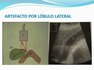 ARTEFACTO POR LÓBULO LATERAL
 