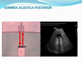 SOMBRA ACÚSTICA POSTERIOR
 