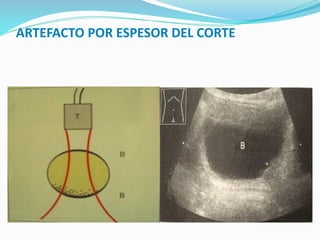 ARTEFACTO POR ESPESOR DEL CORTE
 