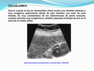 COLA DE COMETA
Ocurre cuando el haz de ultrasonidos choca contra una interfase estrecha y
muy ecogénica apareciendo detrás de esta interfase una serie de ecos
lineales. Es muy característico de los adenomiomas de pared vesicular,
cuerpos extraños muy ecogénicos y también pequeñas burbujas de aire en el
seno de un medio sólido.
adenomiomatosis de la pared de la vesícula biliar (POLIPO)
 