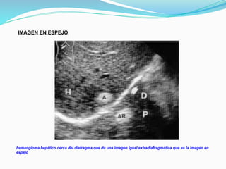 IMAGEN EN ESPEJO
hemangioma hepático cerca del diafragma que da una imagen igual extradiafragmática que es la imagen en
espejo
 