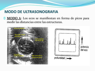 MODO DE ULTRASONOGRAFIA
MODO A: Los ecos se maniﬁestan en forma de picos para
medir las distancias entre las estructuras.
Ecos en modo A
Ecos del cráneo
próximo
Cráneo fetal
(en modo B)
Haz en modo A
(línea de mira)
Ecos del
cráneo alejado
 