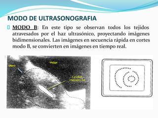 MODO DE ULTRASONOGRAFIA
MODO B: En este tipo se observan todos los tejidos
atravesados por el haz ultrasónico, proyectando imágenes
bidimensionales. Las imágenes en secuencia rápida en cortes
modo B, se convierten en imágenes en tiempo real.
Cavidad
endometrial
Vejiga
Utero
 
