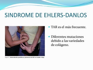 SINDROME DE EHLERS-DANLOS
              TAR es el más frecuente.


              Diferentes mutaciones
              debido a las variedades
              de colágeno.
 