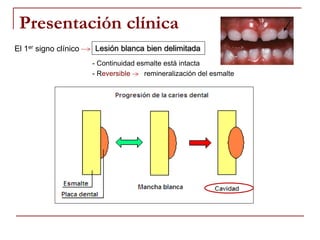 Presentación clínica
Lesión blanca bien delimitadaEl 1er signo clínico
- Continuidad esmalte está intacta
- Reversible remineralización del esmalte
 