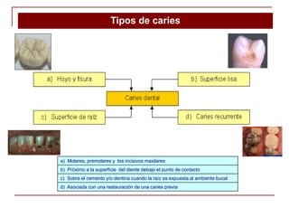 Tipos de caries
a) Molares, premolares y los incisivos maxilares
b) Próximo a la superficie del diente debajo el punto de contacto
c) Sobre el cemento y/o dentina cuando la raíz es expuesta al ambiente bucal
d) Asociada con una restauración de una caries previa
 
