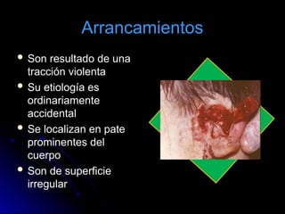 Arrancamientos
 Son resultado de una
tracción violenta
 Su etiología es
ordinariamente
accidental
 Se localizan en pate
prominentes del
cuerpo
 Son de superficie
irregular
 