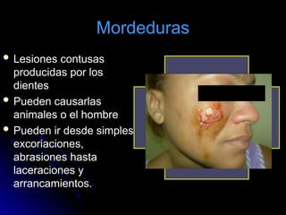 Mordeduras
 Lesiones contusas
producidas por los
dientes
 Pueden causarlas
animales o el hombre
 Pueden ir desde simples
excoriaciones,
abrasiones hasta
laceraciones y
arrancamientos.
 