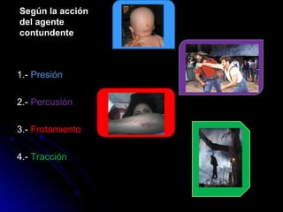 Según la acción
del agente
contundente
1.- Presión
2.- Percusión
3.- Frotamiento
4.- Tracción
 