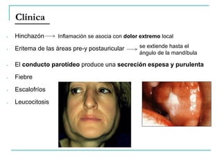 - Hinchazón
- Eritema de las áreas pre-y postauricular
- El conducto parotídeo produce una secreción espesa y purulenta
- Fiebre
- Escalofríos
- Leucocitosis
Clínica
se extiende hasta el
ángulo de la mandíbula
Inflamación se asocia con dolor extremo local
 