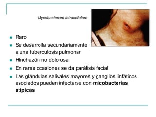  Raro
 Se desarrolla secundariamente
a una tuberculosis pulmonar
 Hinchazón no dolorosa
 En raras ocasiones se da parálisis facial
 Las glándulas salivales mayores y ganglios linfáticos
asociados pueden infectarse con micobacterias
atípicas
Mycobacterium intracellulare
 