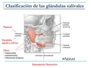 Clasificación de las glándulas salivales
Paperas
Parotiditis
aguda y crónica
Sialoadenitis Obstructiva
Otros:
- tuberculosis
- actinomicosis
- infecciones fúngicas
 