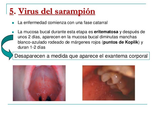 infecciones bacterianas y víricas de la mucosa oral