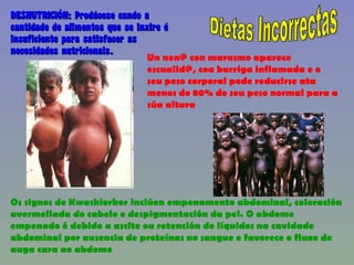 Dietas Incorrectas DESNUTRICIÓN: Prodúcese cando a cantidade de alimentos que se inxire é insuficiente para satisfacer as necesidades nutricionais. Un nen@ con marasmo aparece escualid@, coa barriga inflamada e o seu peso corporal pode reducirse ata menos do 80% do seu peso normal para a súa altura  Os signos de Kwashiorkor inclúen empenamento abdominal, coloración avermellada do cabelo e despigmentación da pel. O abdome empenado é debido a ascite ou retención de líquidos na cavidade abdominal por ausencia de proteínas no sangue e favorece o fluxo de auga cara ao abdome  