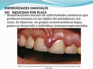 Lesiones Raras TEMA 2 CLASIFICACION Y EPIDEMIOLOGÍA DE ENFERMEDADES PERIODONTALES.pptx