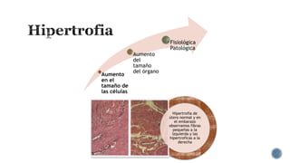 Aumento
en el
tamaño de
las células

Aumento
del
tamaño
del órgano

Fisiológica
Patológica

Hipertrofia de
útero normal y en
el embarazo
observamos fibras
pequeñas a la
izquierda y las
hipertroficas a la
derecha

 