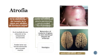 Es la disminución
del tamaño de la
célula por pérdida
de sustancia celular

Cuando las condiciones
adversa persisten las
células pueden
morirFisiológica

Es el resultado de una
reducción en los
componentes
estructurales

Notocorda o el
conducto tirogloso,
el útero disminuye
después del
embarazo

Pueden tener una
función disminuida
pero no están
muertas

Patológica
Conducto tirogloso y atrofia cerebral

 