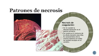 Necrosis de
coagulación:
• Se ve cuando la
desnaturalización es el
patrón primario.
• Se conserva el contorno de
la célula durante unos días.
Es característico de la
muerte hipóxica en todos
los tejidos excepto en el
cerebro.

 