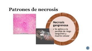 Necrosis
gangrenosa
• Se aplica a la
perdida de riego
sanguíneo y
muerte celular

 