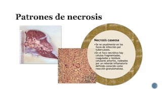 Necrosis caseosa
•Se ve usualmente en los
focos de infección por
tuberculosis.
•En el foco necrótico hay
células fragmentadas,
coaguladas y residuos
celulares amorfos, rodeados
por un reborde inflamatorio
definido conocido como
reacción granulomatosa.

 