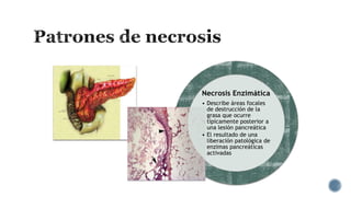 Necrosis Enzimática
• Describe áreas focales
de destrucción de la
grasa que ocurre
típicamente posterior a
una lesión pancreática
• El resultado de una
liberación patológica de
enzimas pancreáticas
activadas

 