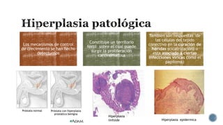 Los mecanismos de control
de crecimiento se han hecho
defectuosos

Constituye un territorio
fértil sobre el cual puede
surgir la proliferación
carcinomatosa

Hiperplasia
linfoide

Tambien son respuestas de
las células del tejido
conectivo en la curación de
heridas (cicatrización) o
esta asociado a ciertas
infecciones víricas como el
papiloma)

Hiperplasia epidermica

 