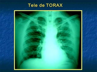 Tele de TORAX

 
