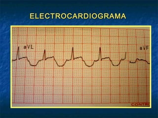 ELECTROCARDIOGRAMA

 